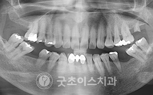 치료전 사진2