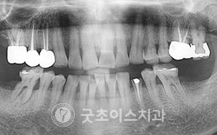 치료전 사진7